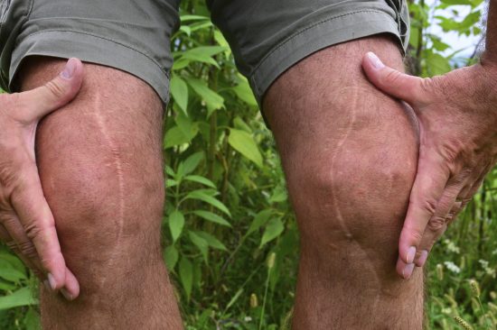 knee-replacement-scar-joint-painiStock_000050830058_Medium